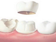 Coroane dentare pret