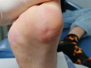 Tratament veruca plantara