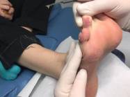 Tratament veruca plantara