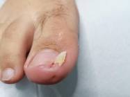 Tratament unghie incarnata