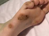 Tratament veruca plantara