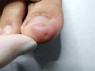 Tratament unghie incarnata