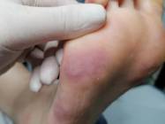 Tratament veruca plantara