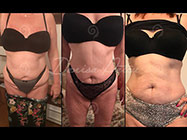 Inel gastric virtual Bucuresti