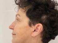 Lipoabdominoplastie Bucuresti