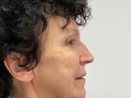 lifting facial Bucuresti