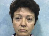 lifting facial Bucuresti