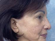 lifting facial Bucuresti