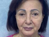 Lipoabdominoplastie Bucuresti