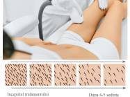 Epilare definitiva laser Gara de Nord