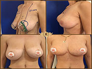 chirurgie plastica sector 4