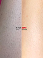 Salon epilare definitiva 3 Laser Beauty