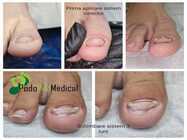 pedichiura-medicala-podpedmedical