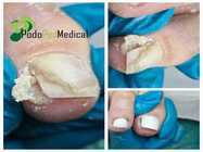 tratamente de pedichiura medicala