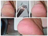 tratamente micoza unghiei