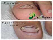 tratamente micoza unghiei