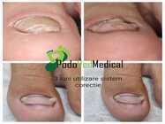 tratament paranichia bucuresti