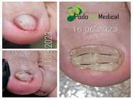 tratament paranichia bucuresti