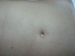 epilare abdomen