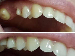 implant dentar