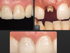 implant dentar