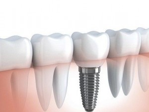 implant dentar