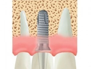 implant dentar