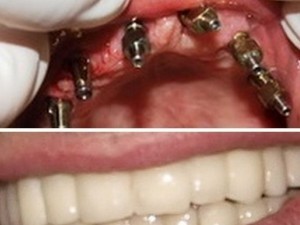 implant dentar