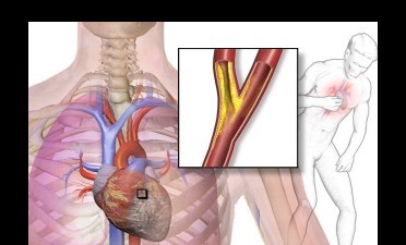 Angina pectorala