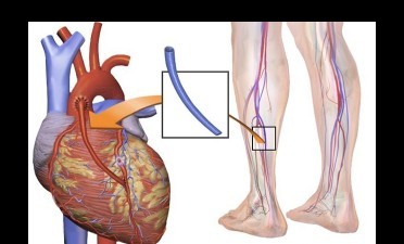 Angina pectorala