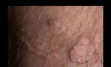 Infecţia cu virusul HPV şi riscul de cancer