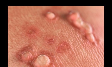 viermii pot provoca alergii papilloma in medicine