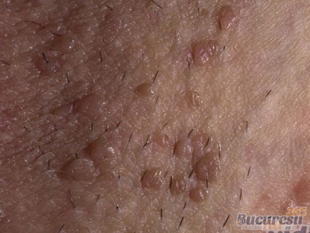 Infectia cu HPV din perspectiva dermatologului