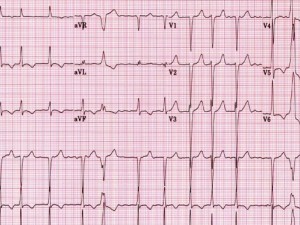 Electrocardiograma - EKG