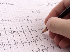 Electrocardiograma - EKG