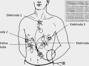 Electrocardiograma - EKG