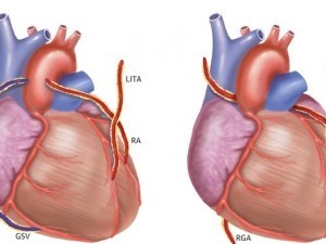 Bypass coronarian