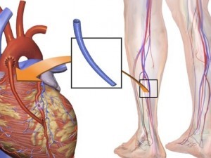 Bypass coronarian