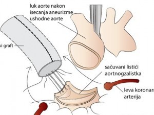 Bypass coronarian