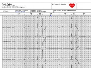 Holter ECG