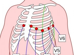 Holter ECG