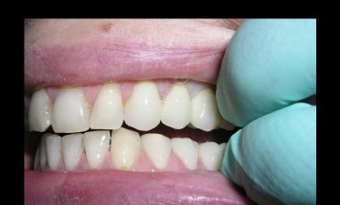Coroane dentare