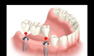 Coroane dentare